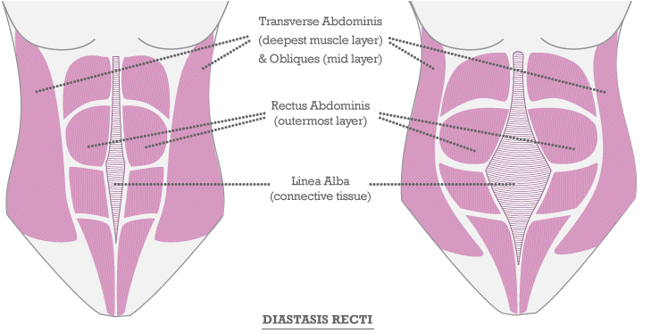 Abdominal Separation Before And After
