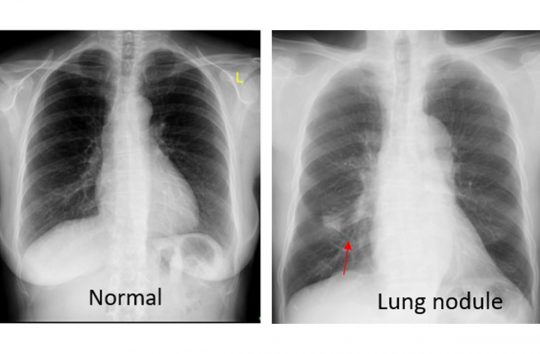 Abnormal Chest Xray Icd 10
