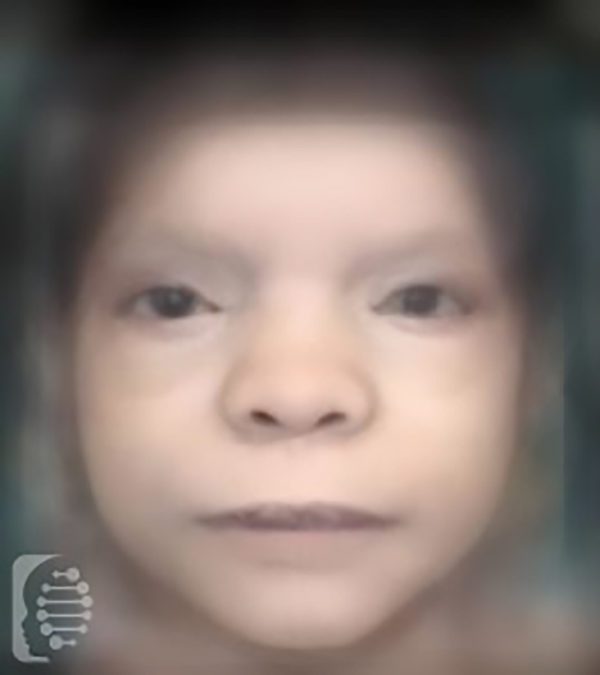 Barber Say Syndrome Photos