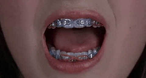 Braces Porn Gifs