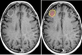 Breast Cancer Brain Mets Stories