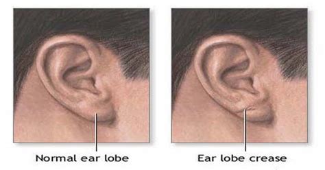 Crease In Ear Lobe And Heart Disease