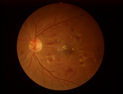 5 Ways Dot Blot HemorrhageOccurs
