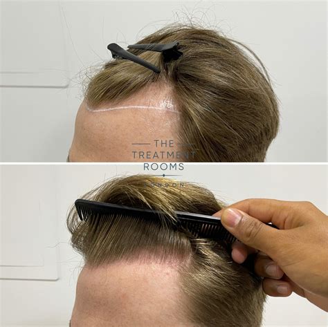 Hair Surgery For Receding Hairline