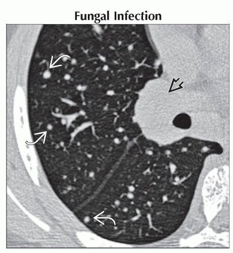 How To Code Multiple Pulmonary Nodules? Icd10 Made Easy