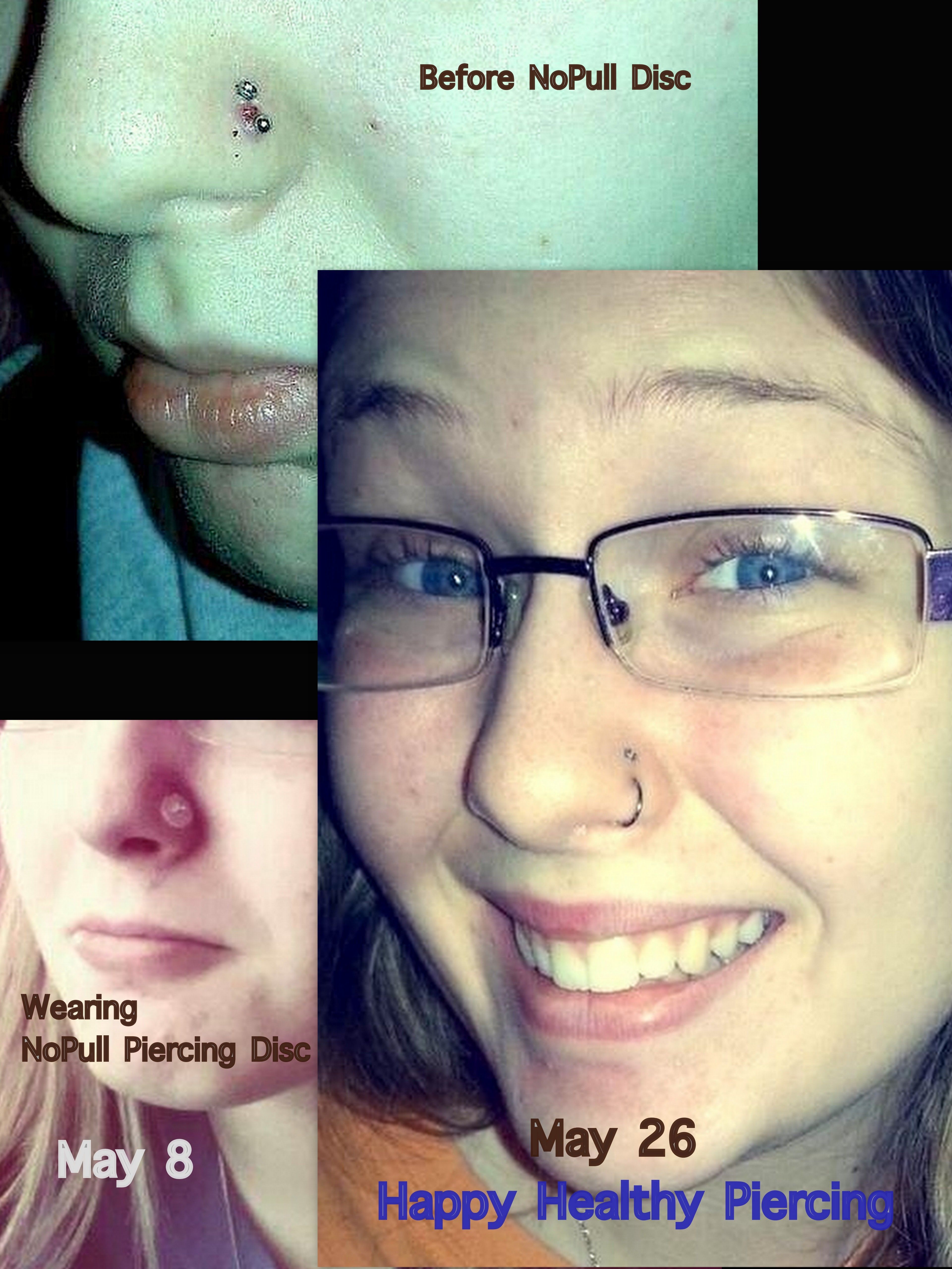 Hypertrophic Scar On Nose Piercing Guide Hypertrophic Scar On Nose Piercing Guide