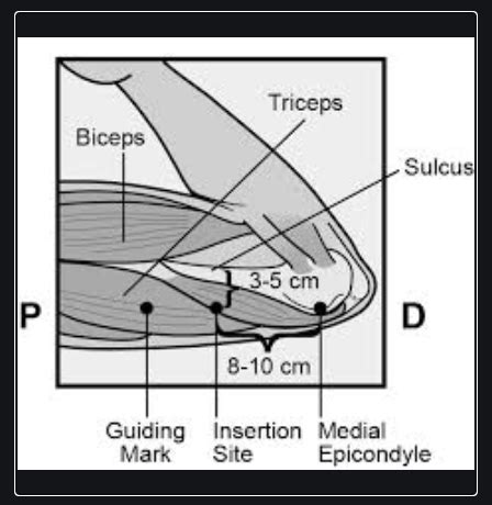 Nexplanon Insertion Steps Nexplanon Insertion Steps