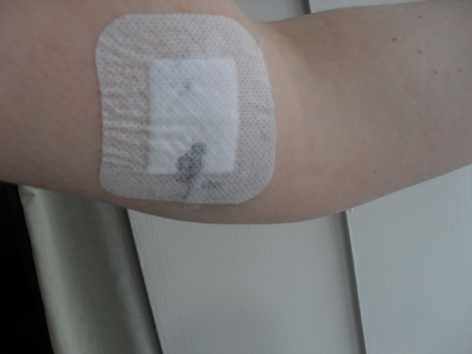 Nexplanon Removal Steps Nexplanon Removal Steps
