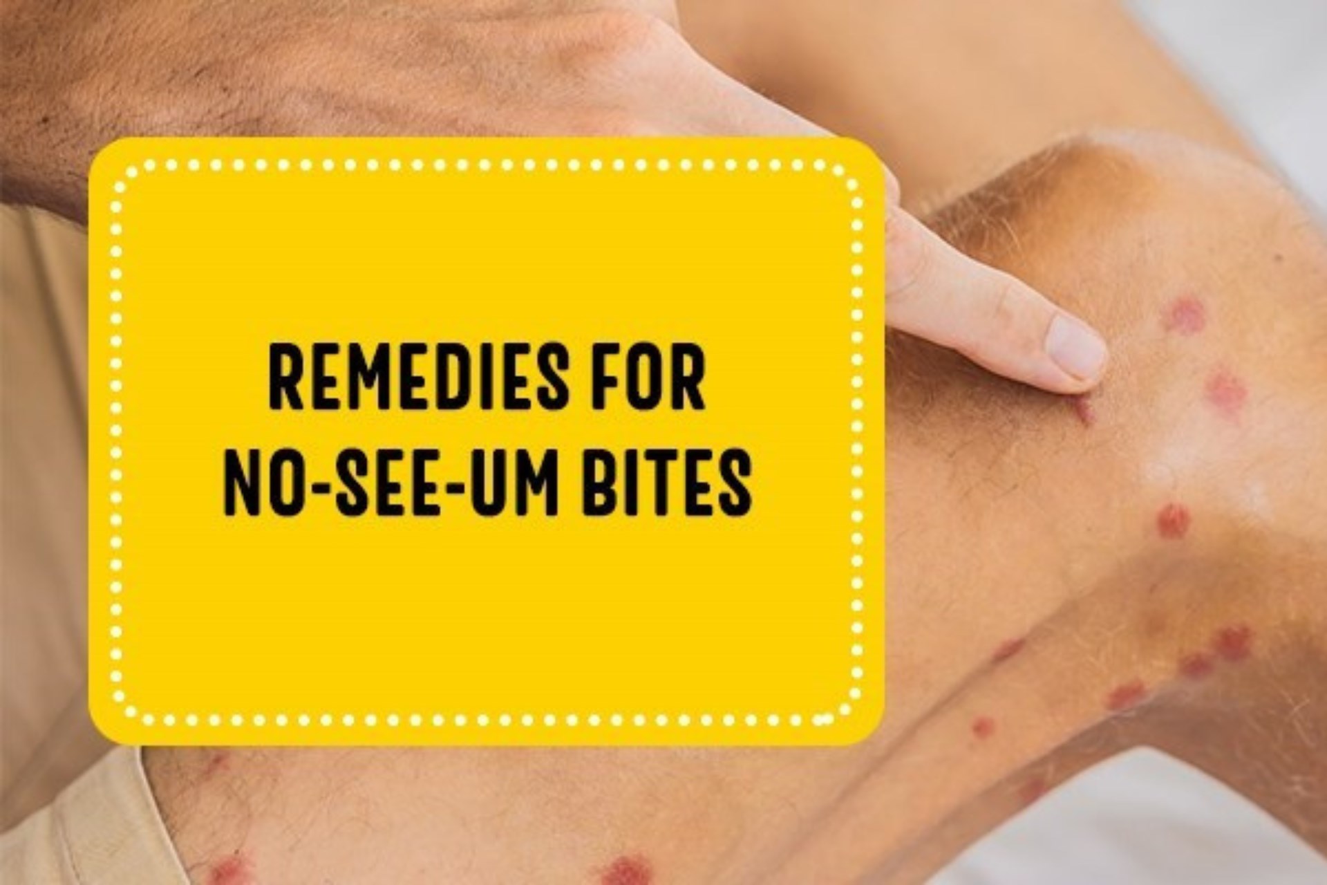 No See Um Bite Relief: Fast Remedies