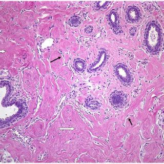 Pash Cancer Risk: Know The Symptoms