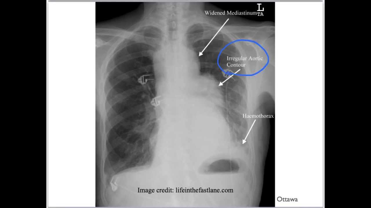 Pistol Shot Femoral Pulse: Diagnose Aortic Dissection