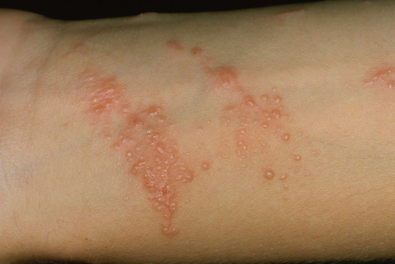 Poison Ivy: Identify And Treat Rash