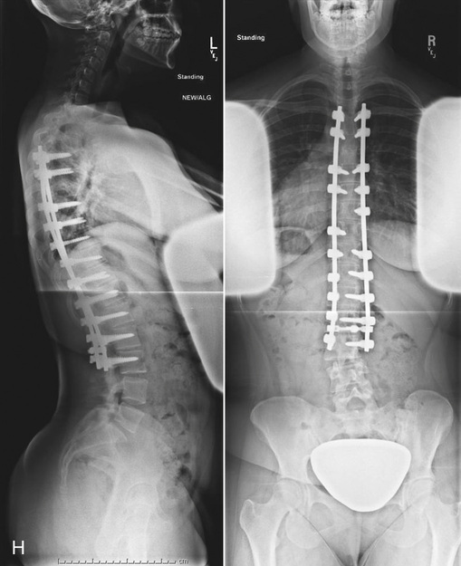 Posterior Spinal Fusion With Instrumentation Posterior Spinal Fusion With Instrumentation