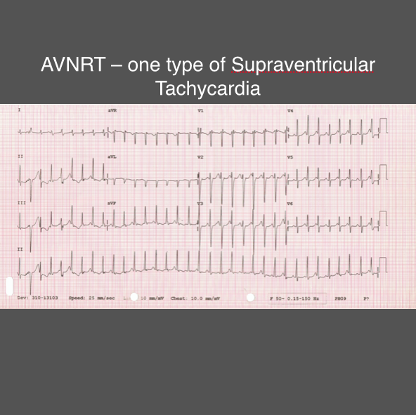 R00 2 Palpitations