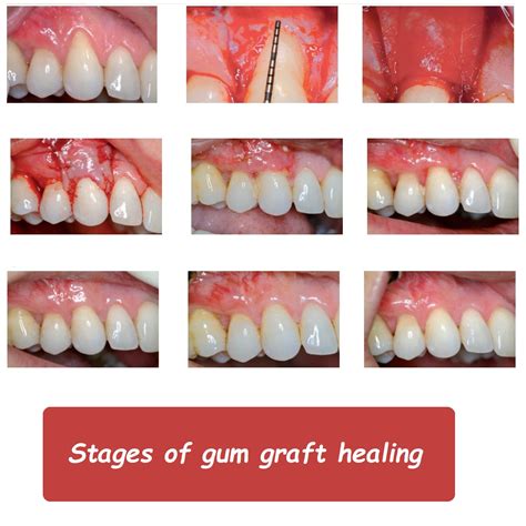 Soft Tissue Grafting Success: Heal Faster