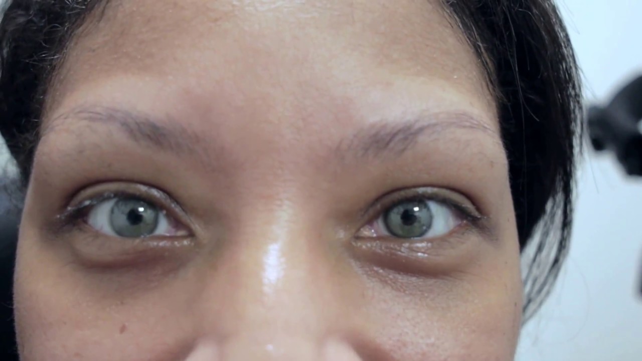 Surgery for Asian Eyes Surgery for Asian Eyes