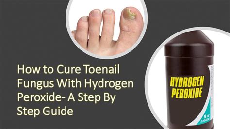 Toenail Fungus Cure Guide