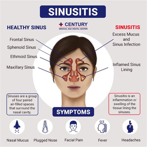 Viral Sinusitis Facts: Is It Contagious?