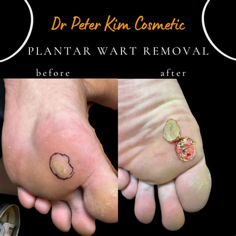 Wart Removal Laser Treatment