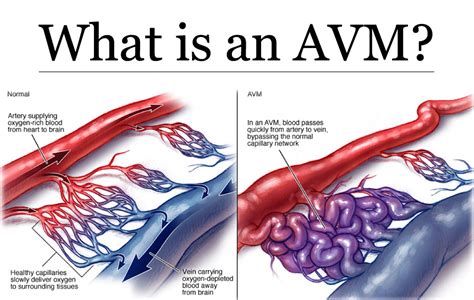What Is An Av