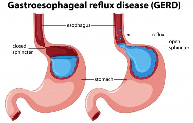 What Is Icd 9 For Acid Reflux? Diagnosis Code Guide What Is Icd 9 For Acid Reflux? Diagnosis Code Guide